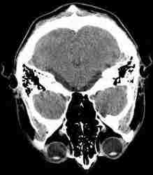 CT scan hoofd