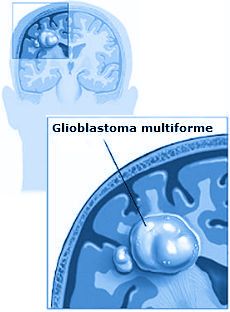 Glioblastoma multiforme gbm hersentumor glioblastoom