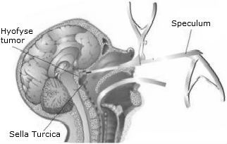 Hypofyse tumor hersentumor operatie speculum