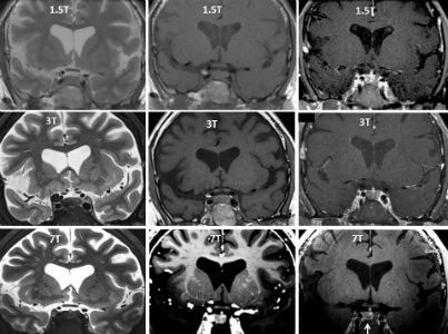Verschil MRI 7T hersentumor scan diagnose
