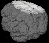 hersentumor MRI laagjes plakjes foto