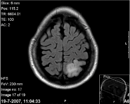 hersentumor diagnose MRI scan