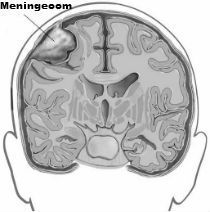 meningeoom hersentumor