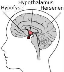 Hypfyse hersentumor